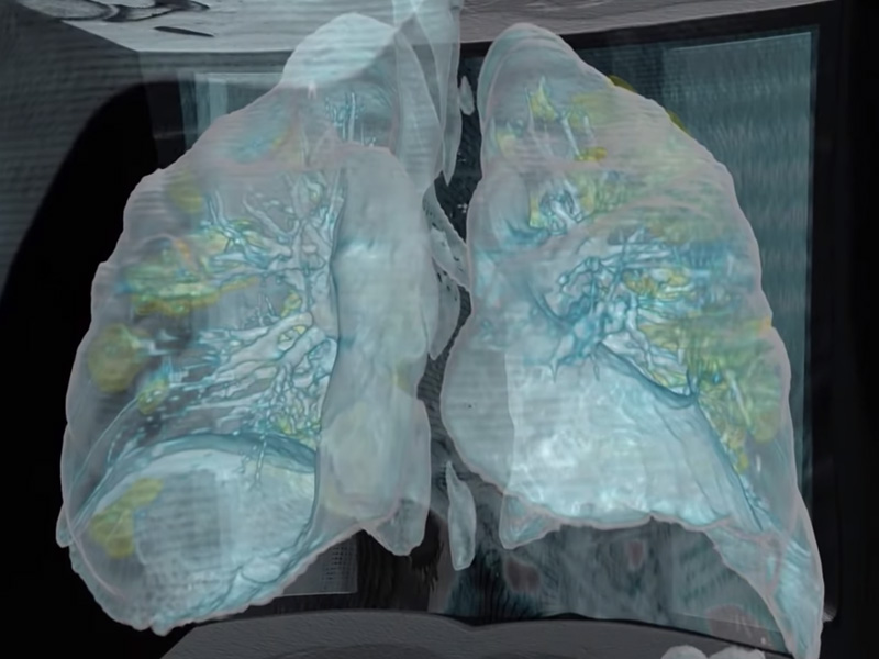 VR 帶你看被冠狀病毒侵蝕後的肺部