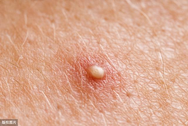 HPV 感染一定是性生活導致的嗎？