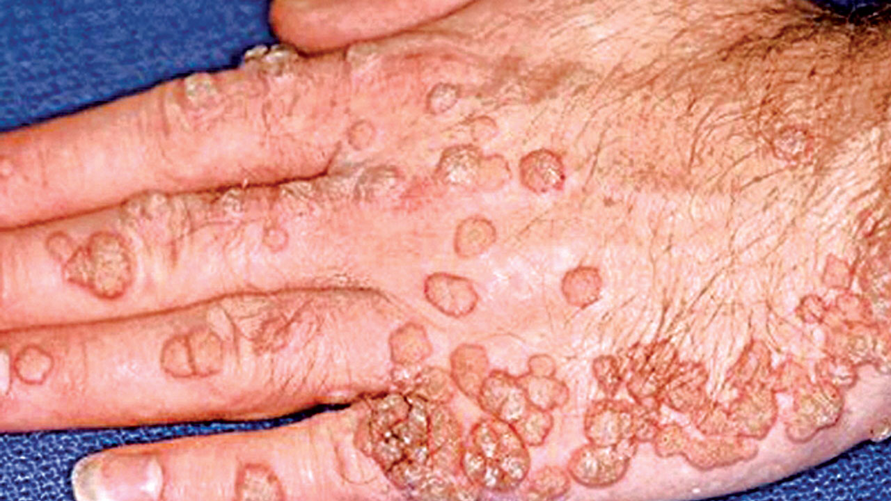 HPV 感染一定是性生活導致的嗎？
