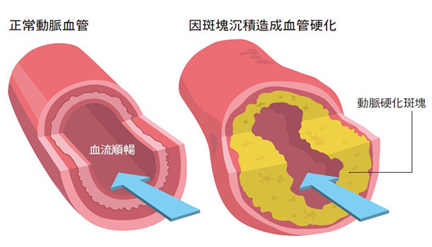 只用一隻手指 就知道血管阻塞了沒