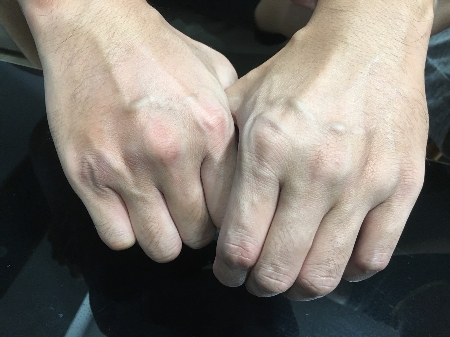 只用一隻手指 就知道血管阻塞了沒