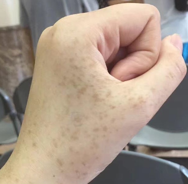 這 5 個部位長黑斑，可能腸胃癌變