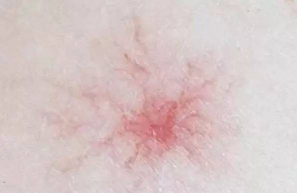 皮膚出現 4 症狀，可能已經有肝癌