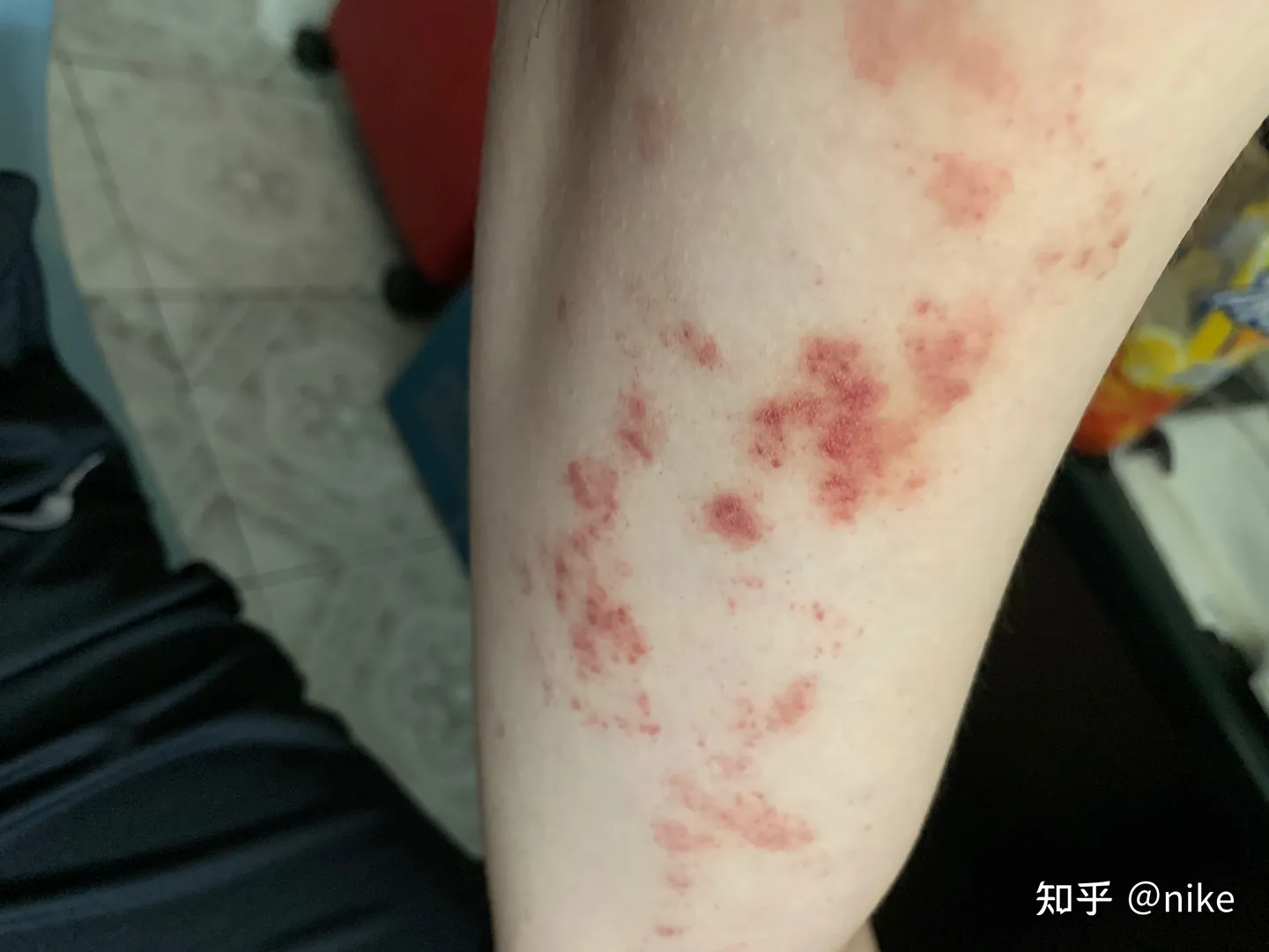 皮膚出現 4 症狀，可能已經有肝癌