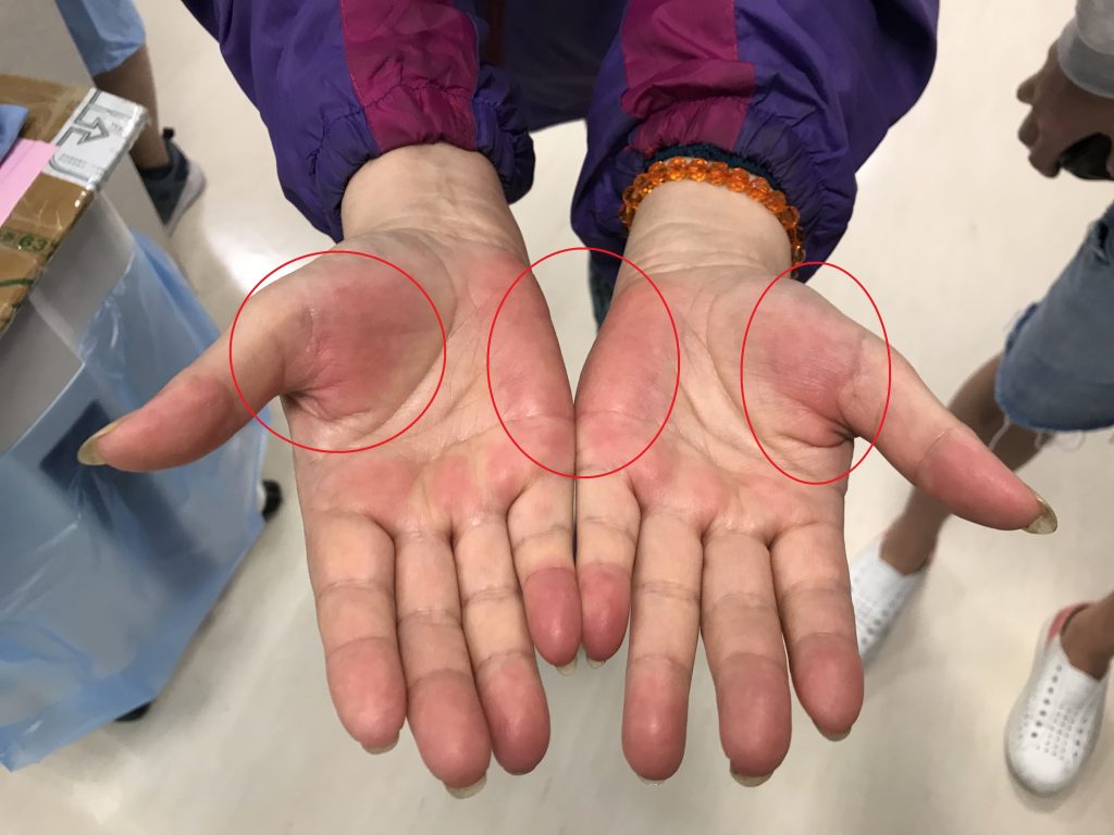 身上有癌手腳先知 4 異常特徵早發現能救命