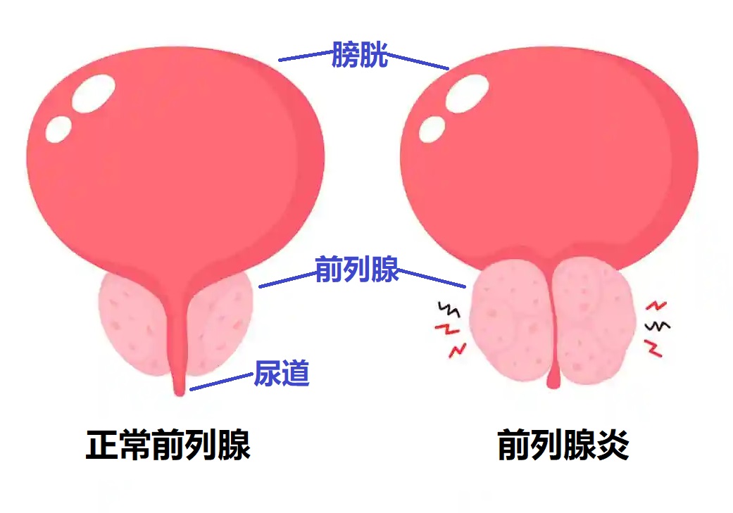男性若有這 3 種異常，或是前列腺炎來了