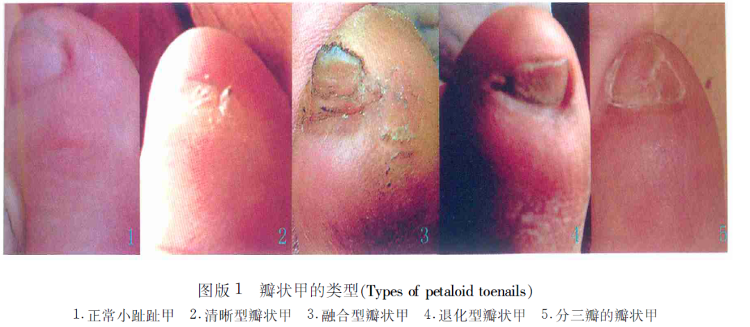 小腳趾指甲分成兩瓣的人，到底是什麼來歷？