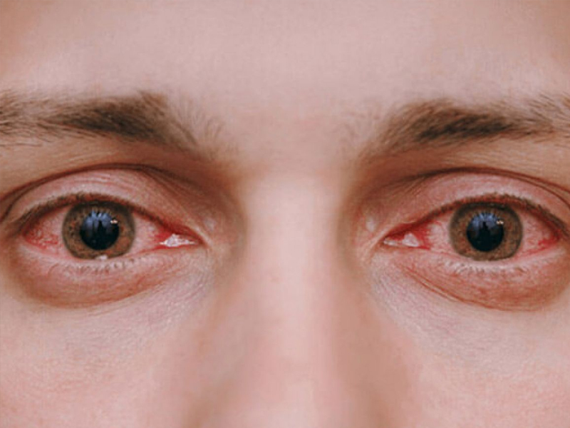 眼睛出現 4 種異象，警惕心血管出現病變