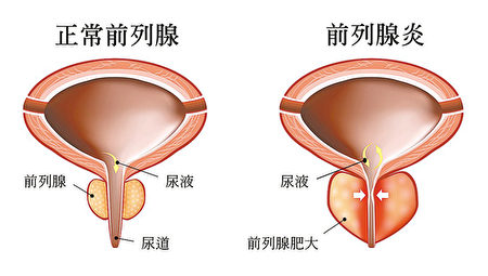 不想有前列腺炎，要多吃這 2 種維生素