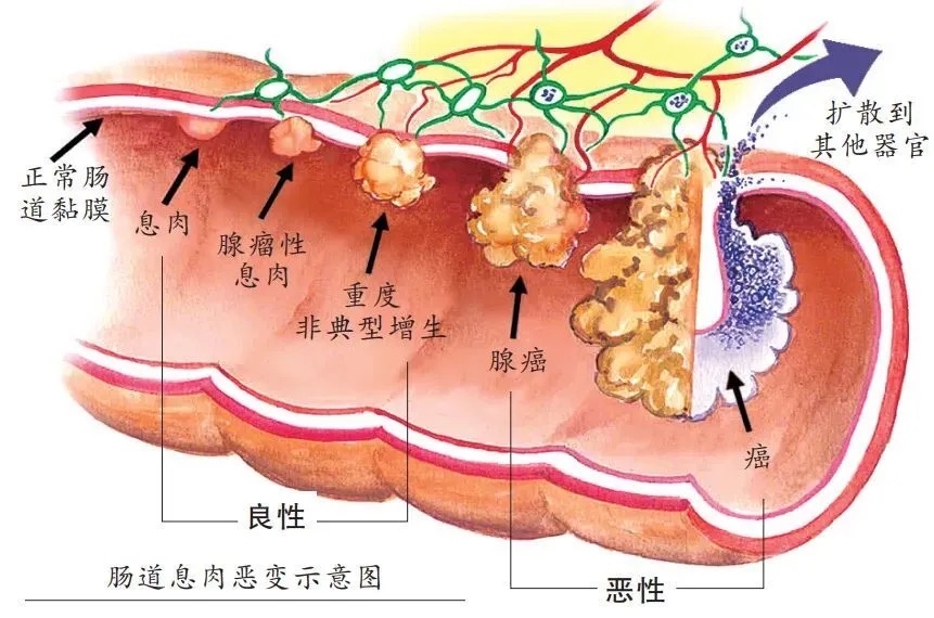 為什麼一發現腸息肉就要切除