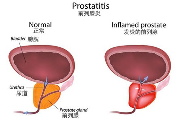 男性 40 歲後不想有前列腺炎，4 個行為要少做