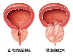 攝護腺肥大原因、前兆症狀