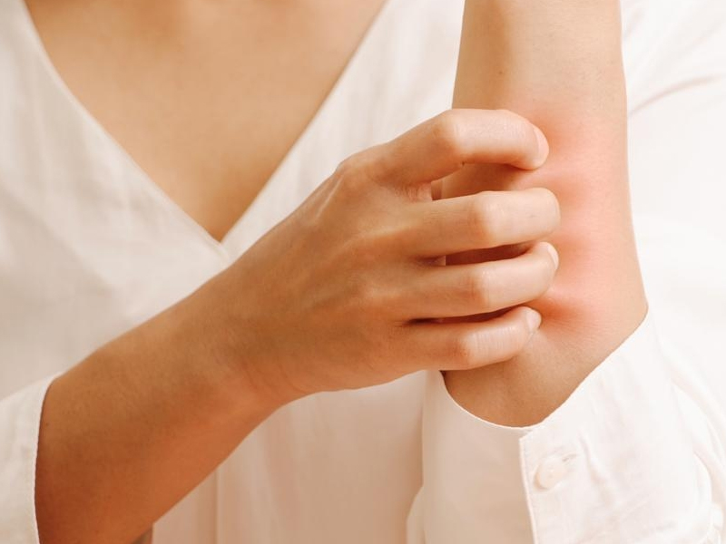 婦人全身瘙癢,竟是胰臟癌晚期警號 婦人全身瘙癢,竟是胰臟癌晚期警號