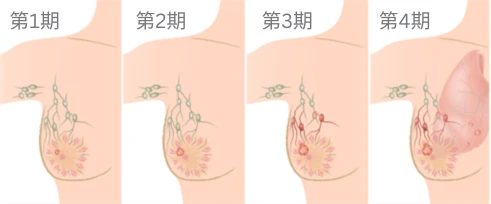 前港姐乳癌惡化，第四期癌細胞擴散