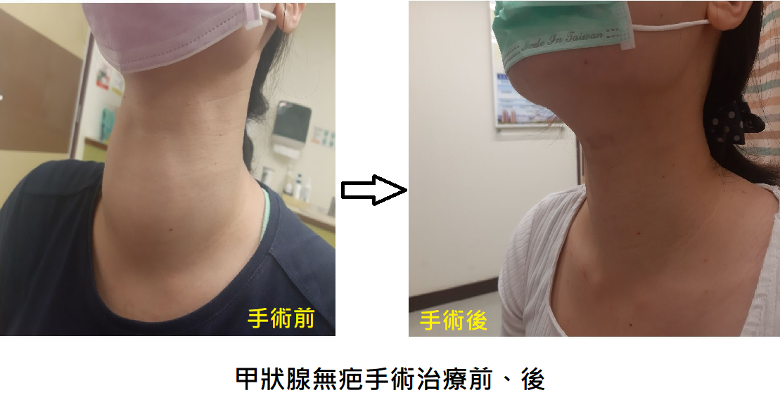 香港 10 癌 1 甲！甲狀腺檢查必須做